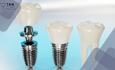 Trồng răng Implant trả góp có nên hay không?