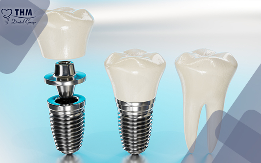 Trồng răng Implant trả góp có nên hay không?