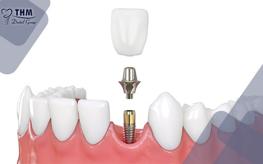 Cấy ghép răng Implant uy tín