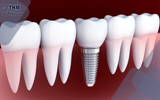 Trồng răng sứ vĩnh viễn cố định trong cung hàm răng