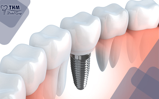 Trụ Implant đem lại tính thẩm mỹ cho răng