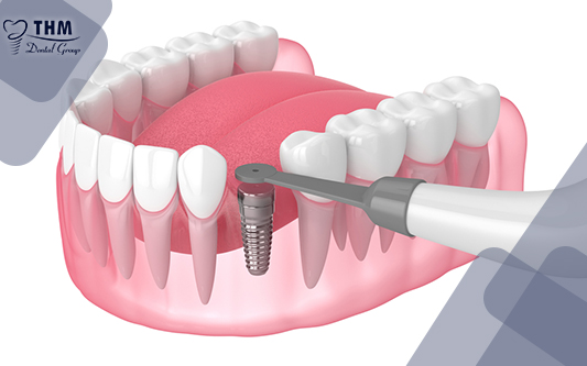 Trụ Implant được cấy ghép trong cung hàm răng giúp cố định răng
