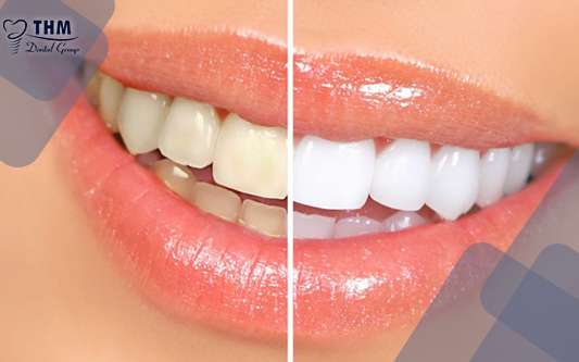 Trước và sau khi bọc răng sứ