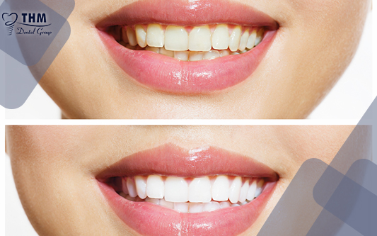 Trước và sau khi dán răng sứ