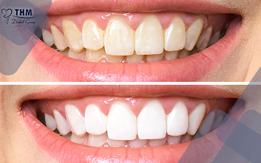 Trường hợp trước và sau khi làm răng sứ