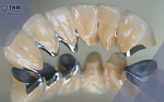 Tuổi thọ trung bình của răng sứ Titan chỉ kéo dài từ 7-15 năm
