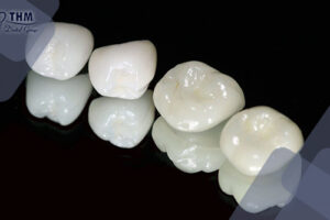 Bảng giá 83 Ưu điểm và nhược điểm của răng sứ zirconia