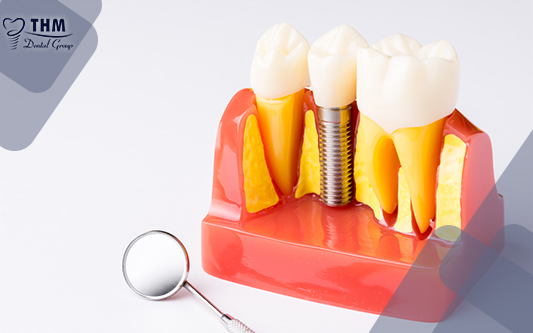 Yếu tố ảnh hưởng tới trồng răng Implant