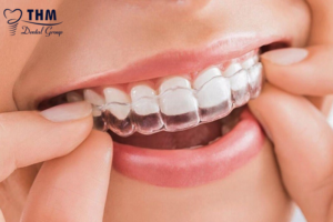 Bảng giá 101 mac cai Invisalign + logo